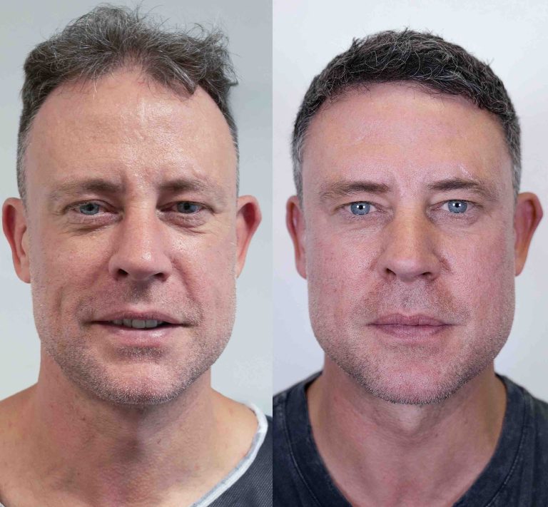 Wayne Bridge shows off the incredible results of his £7,000 hair transplant at DHI Global in London and says: “I’m buzzing.”